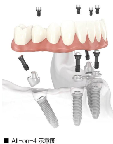 　　牙齿种植
