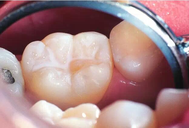 窝沟封闭效果图